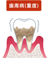 歯周病(重度)