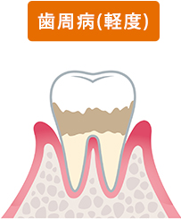 歯周病(軽度)